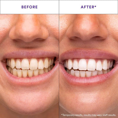 Hismile V34 Whitening Strips, Teeth Whitening Strips, Purple Tooth Whitening, Tooth Stain Treatment, Combining Whitening and Colour Correction